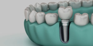 dental implant model gloucester ma